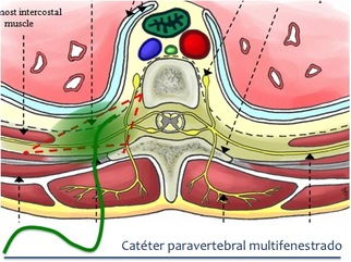 catéter paravertebral torácico