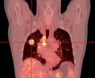 cáncer de pulmón PET nódulo