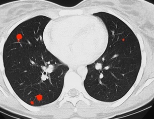 metástasis pulmonares TAC